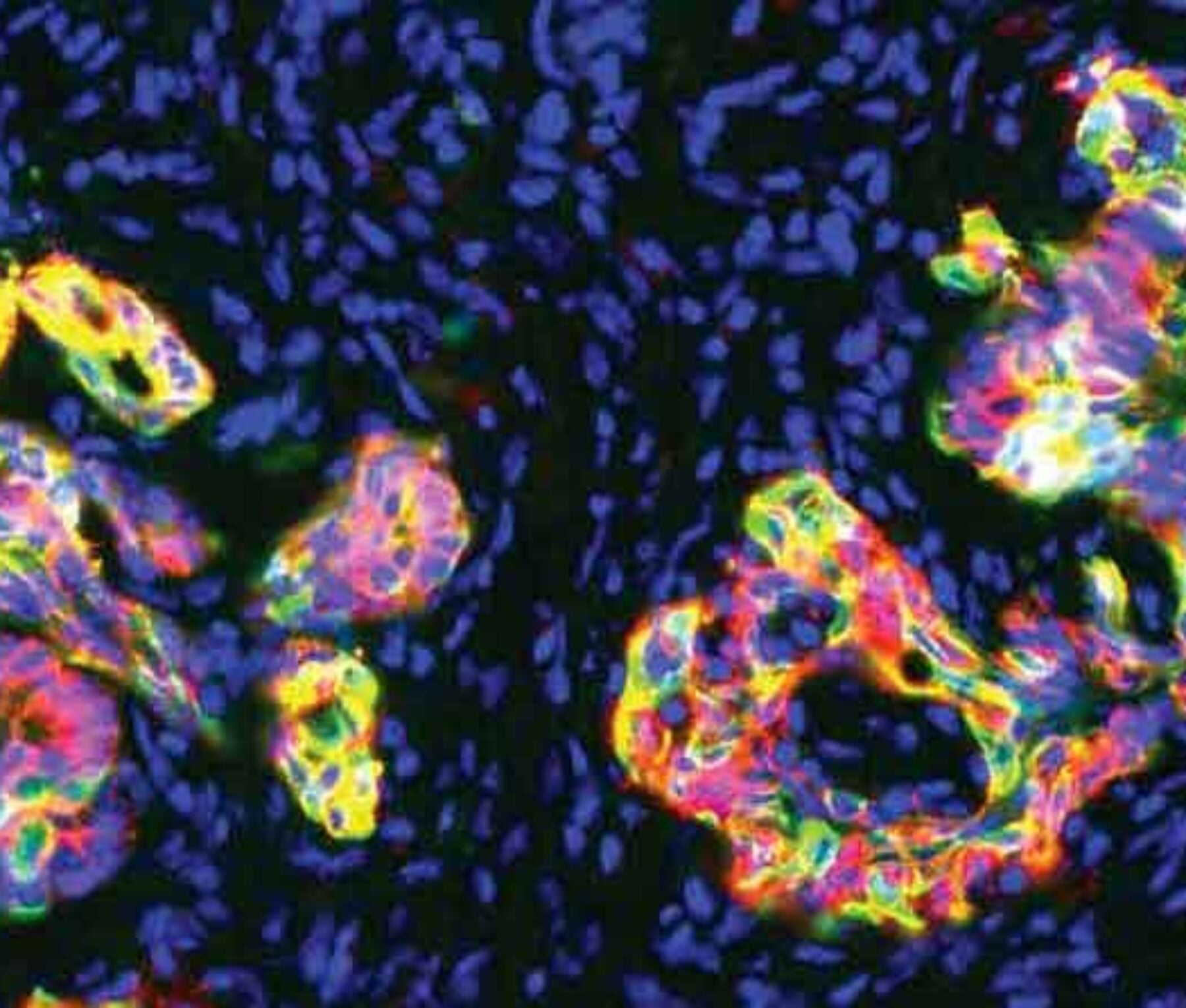 imaging of pancreatic cancer