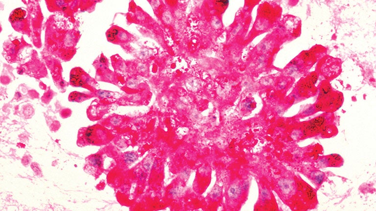 imaging of Ewing sarcoma: a pink sea anemone looking object