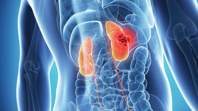 graphic of x ray of person with kidney cancer