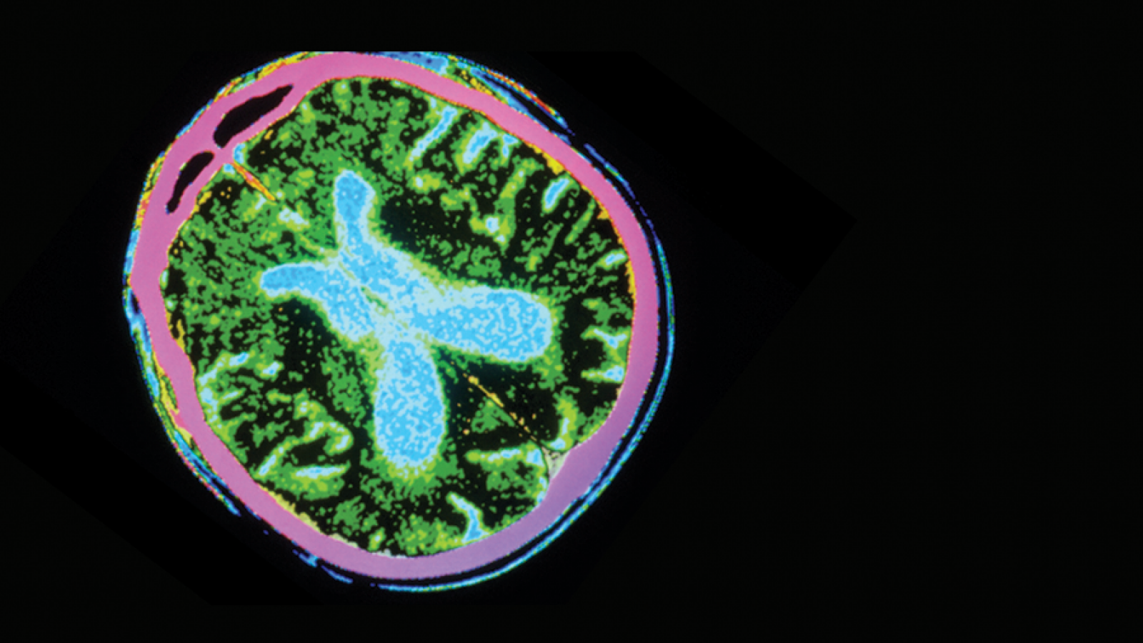 brain imaging of parkinson's