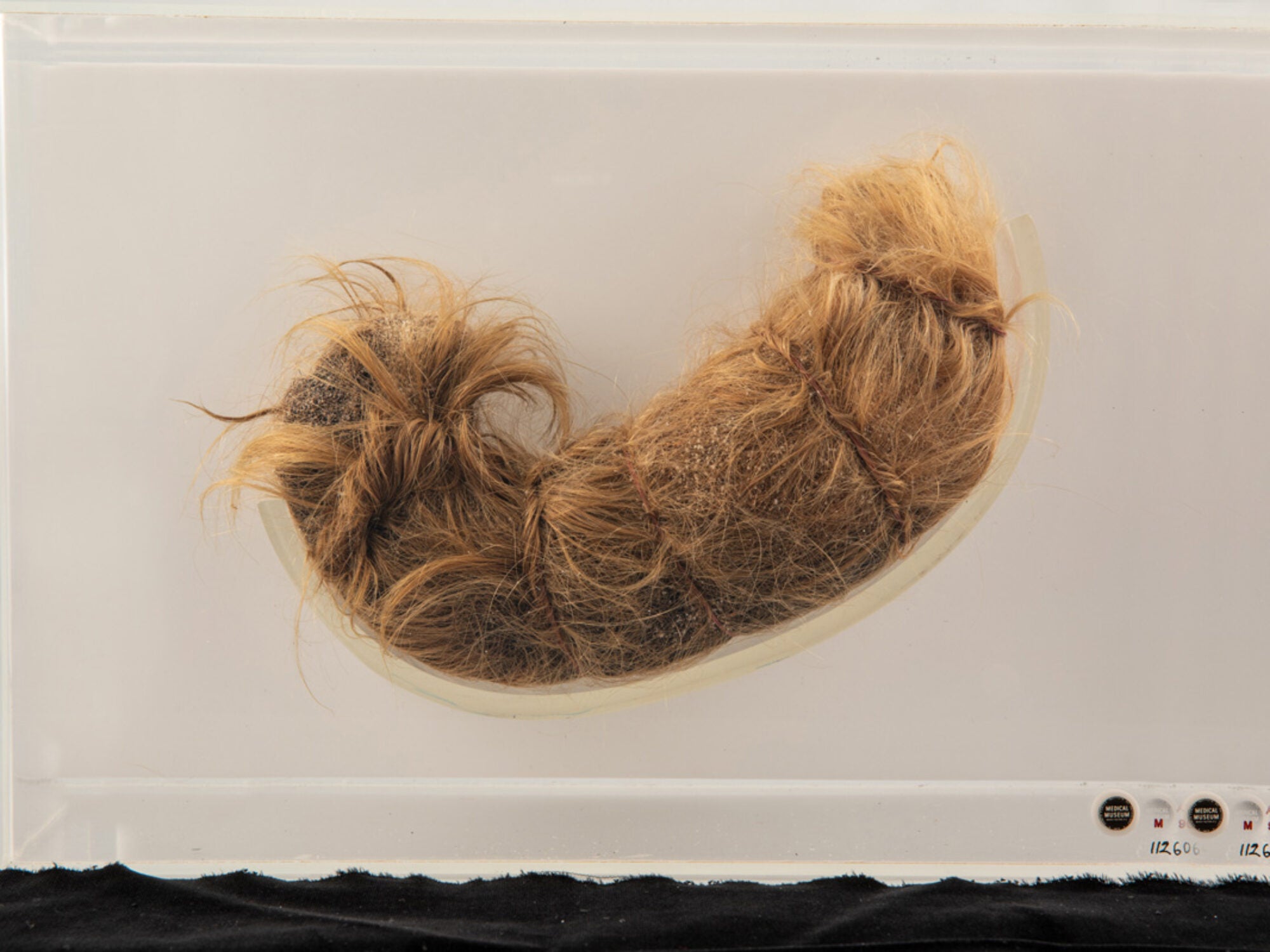 This legendary stomach-shaped hairball from the collection at the National Museum of Health and Medicine in Silver Spring, Maryland, was removed from a 12-year-old girl.