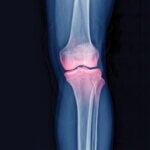 an x-ray of a knee