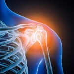 shoulder injury xray