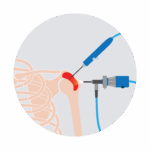 injection into shoulder